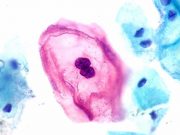 Community-based screening model pushed to curb cervical cancer