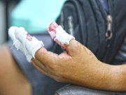 6 new firecracker-related injuries logged in CAR