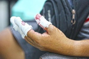 6 new firecracker-related injuries logged in CAR