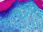 Mexico, Cuba report rare deaths of two patients with monkeypox