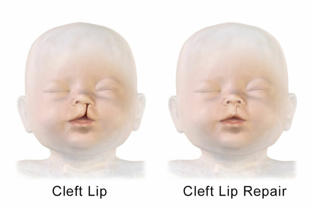 Cleft_Lip_Repair