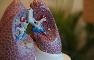 Lung cancer found among non‑smokers; experts urge regular screening