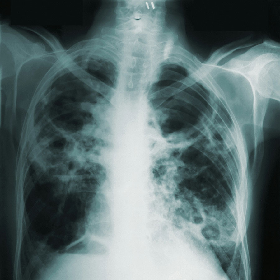tuberculosis
