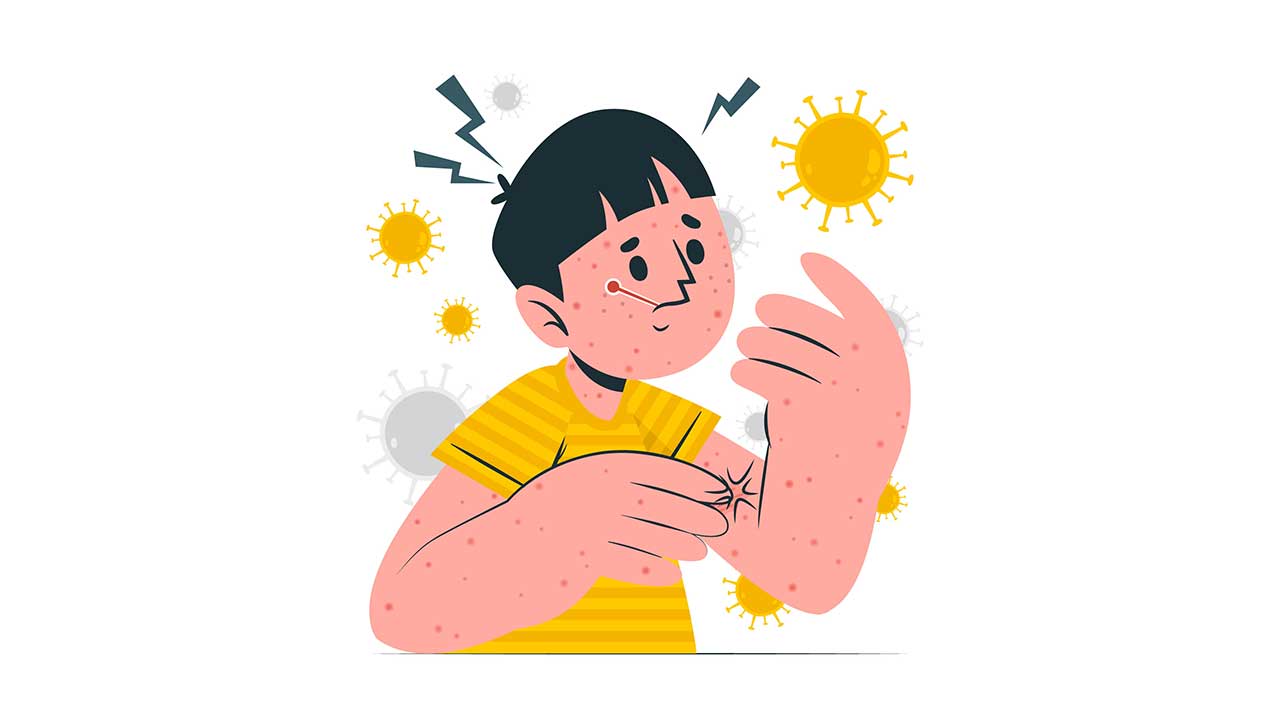 measles
