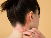 Addressing barriers to shingles prevention