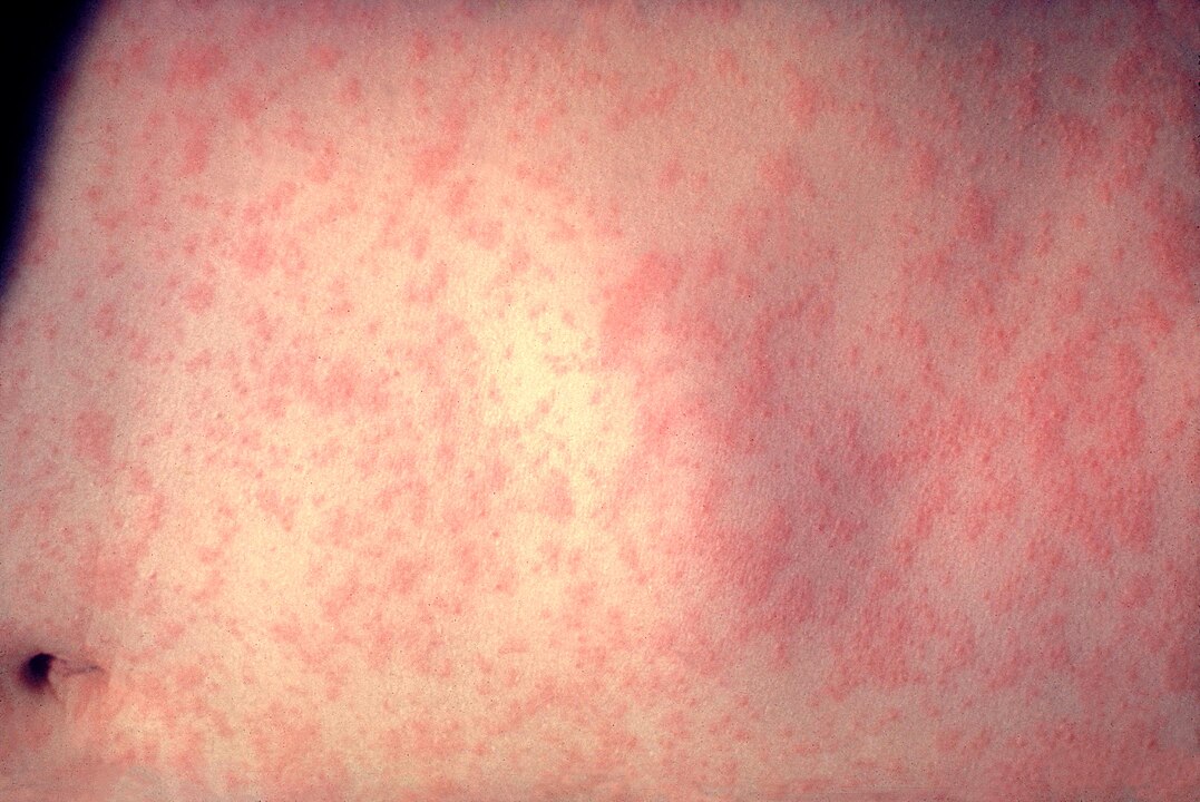 1077px-Morbillivirus_measles_infection