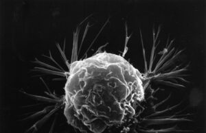 Biopsy won’t spread cancer, says medical expert