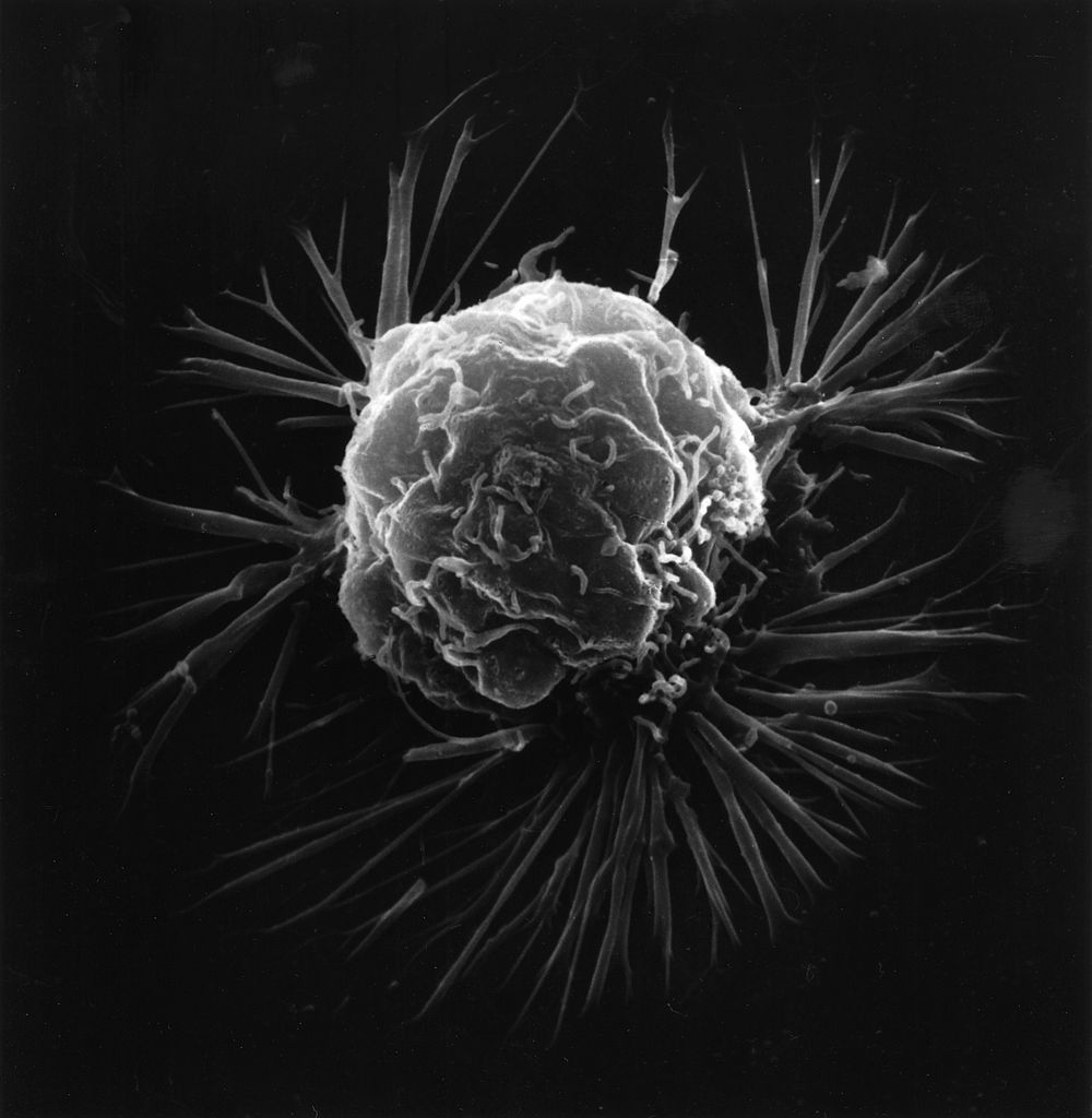 1000px-Breast_cancer_cell